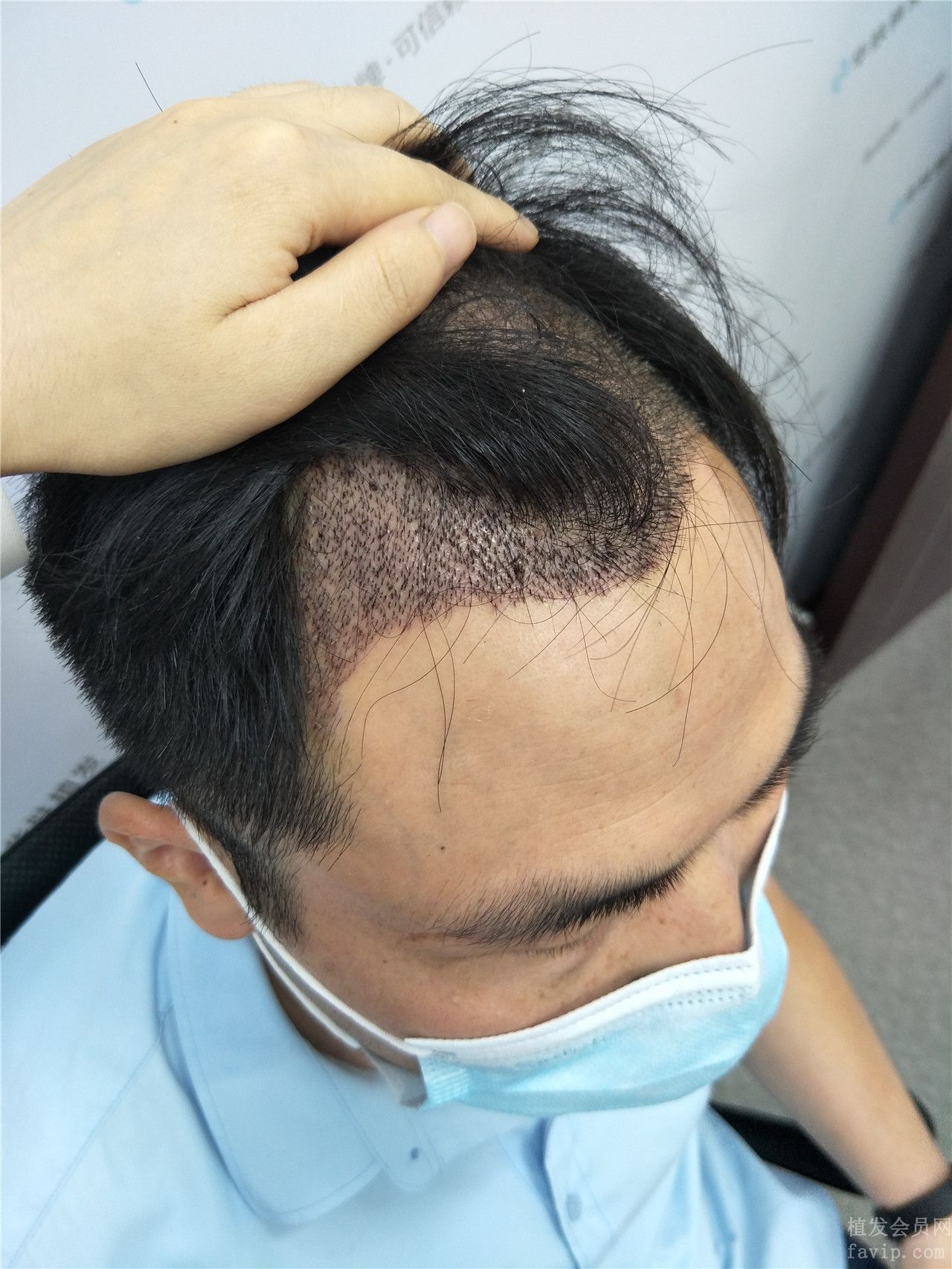 重庆毛发移植，重塑自信的头部美学