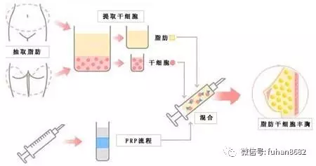 自体脂肪丰胸，专业医院的精细化服务