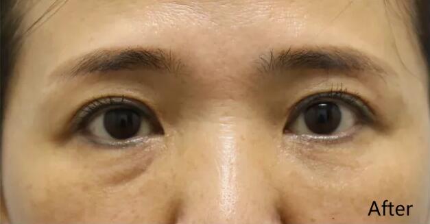 探寻最佳鱼尾纹消除之道，哪里效果最佳？
