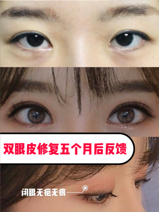 微创双眼皮手术，如何选择最佳的医院
