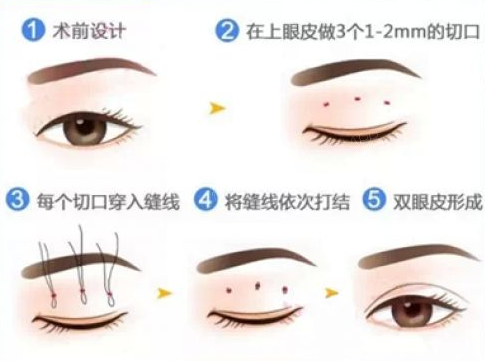 微创双眼皮手术