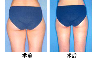 抽脂医院，专业塑形，重塑自信人生的首选之地