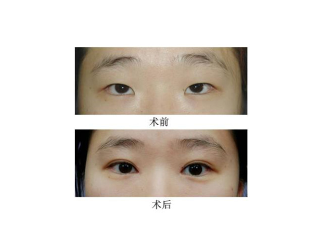 双眼皮手术优惠，美丽与实惠并重的新选择