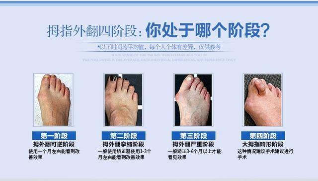 大脚骨治疗，寻找最佳医疗资源的旅程