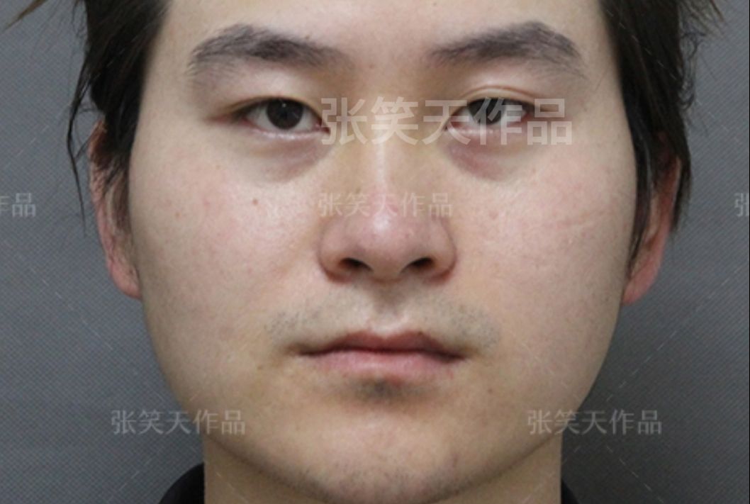 张笑天颧骨整形的探索与实践