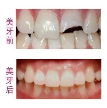 苏州烤瓷牙，传统工艺与现代科技的完美结合
