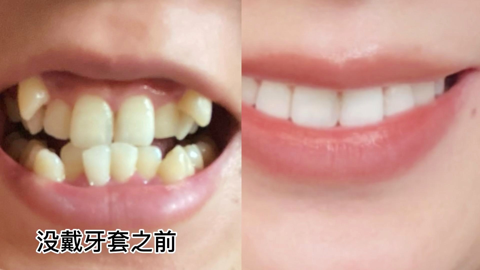 重塑自信微笑
