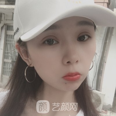 开眼角手术