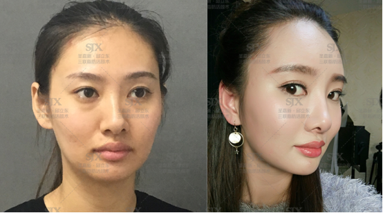伊维兰隆下巴，重塑面部轮廓的美学之选
